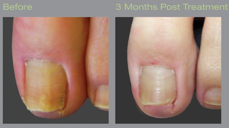 Before-and-After-Laser-1-1.jpg