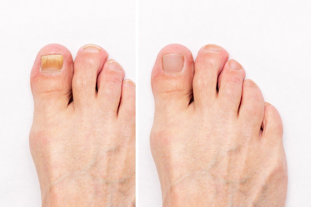 Before-and-after-toenail-fungus-treatment-1.jpg