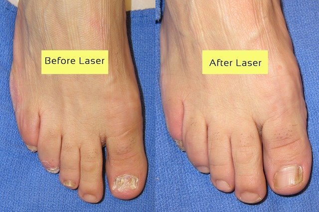 Cutera-Laser-Before-and-After-Picture-p01-1.jpg