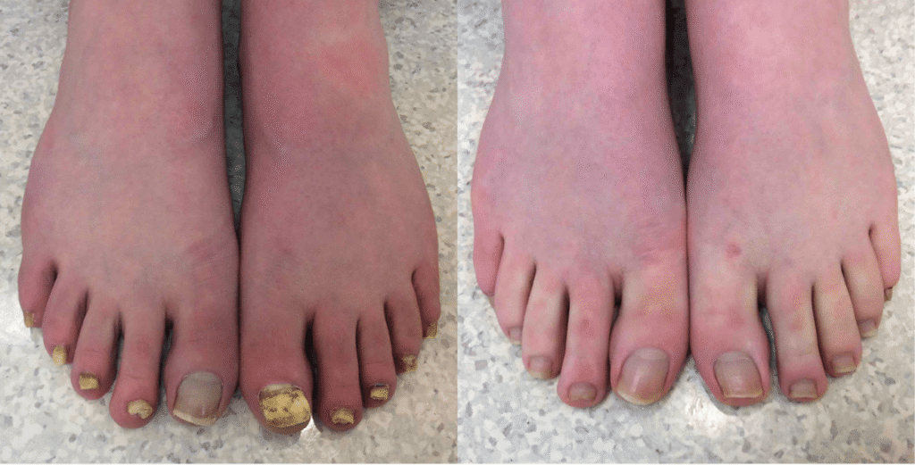 Toenail-Fungus-Treatment-Before-and-After-Patient-1.png