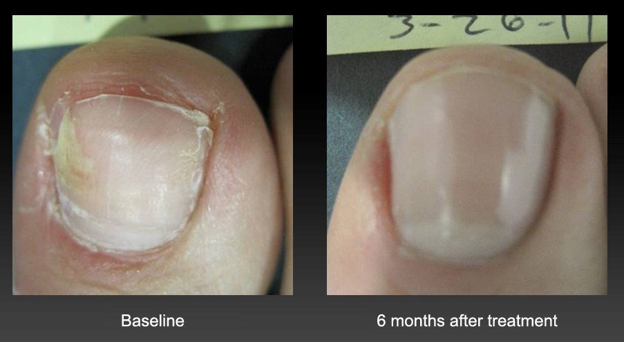 before-after-nail-treatment-1.jpg