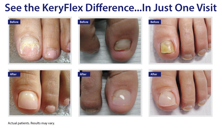 keryflex-real-results-1-1.png